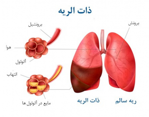 پنومونی