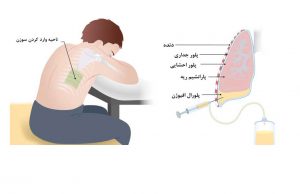 پلورال افیوژن-افزایش مایع اطراف ریه