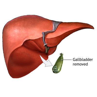 gallbladder removed