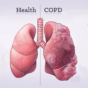 آموزش سلامت COPD