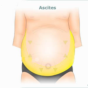 Ascites