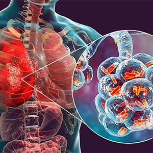 آموزش سلامت Pneumonia