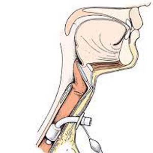 tracheostomy care and suctioning