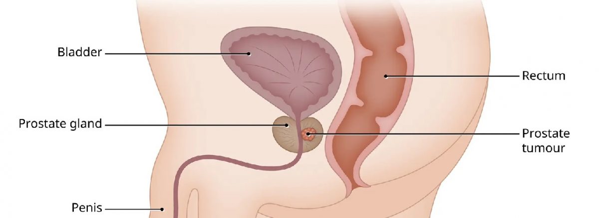 سرطان پروستات