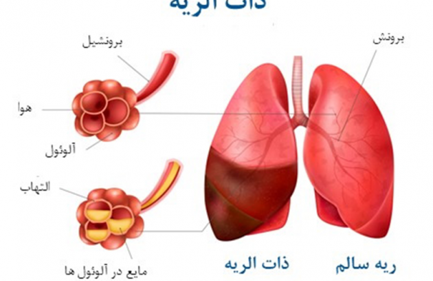پنومونی