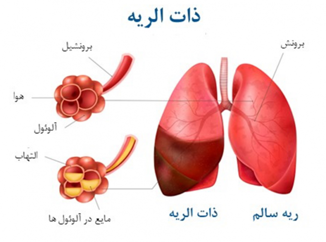 پنومونی عفونت ریه