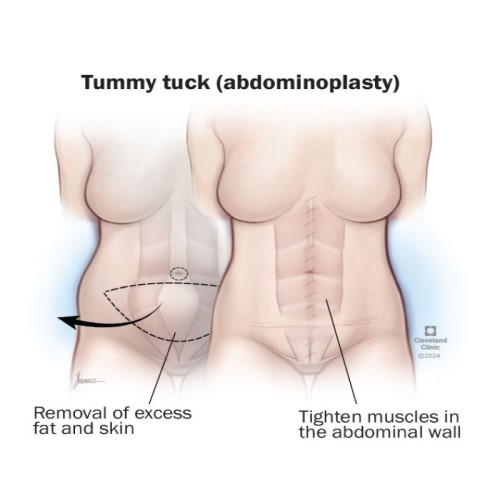 Abdominoplasty (Tummy Tuck)