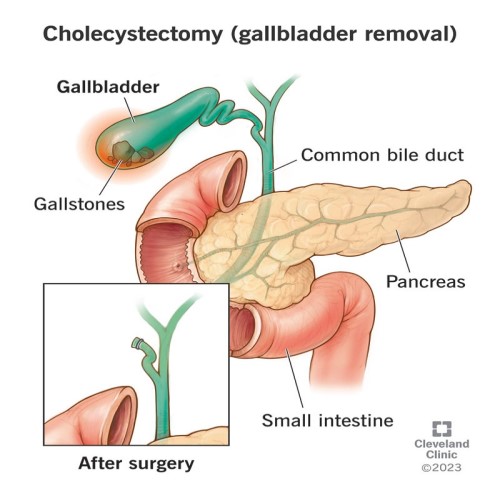 Cholecystectomy