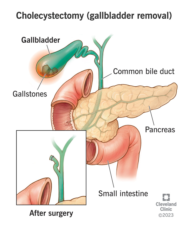 Cholecystectomy