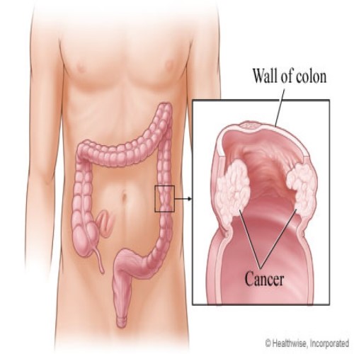 Colon Cancer Surgery