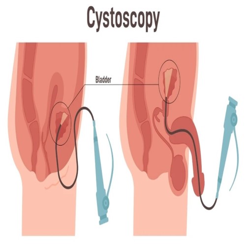Cystourethroscopy