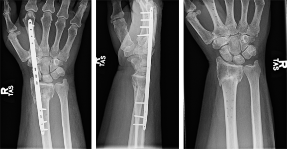 Distal Radius Fracture Surgery