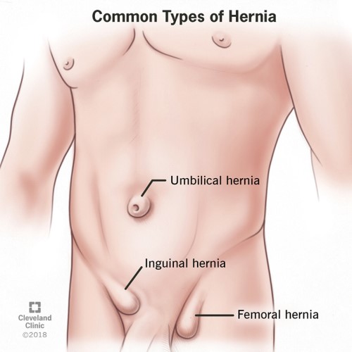 Hernia Surgery