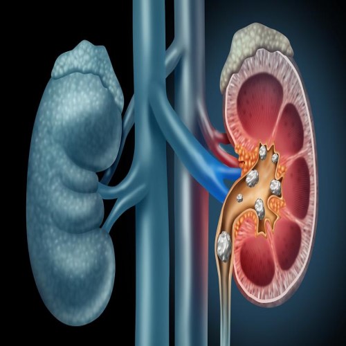 Kidney Stone Surgery
