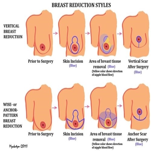 Mammoplasty (Breast Surgery)