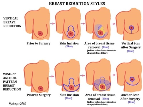 Mammoplasty (Breast Surgery)