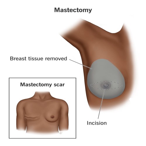 Mastectomy
