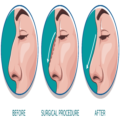 Rhinoplasty (Nose Surgery)