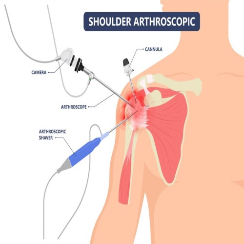 Shoulder Surgery