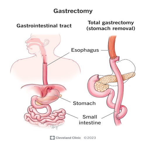Stomach (Gastric) Cancer Surgery