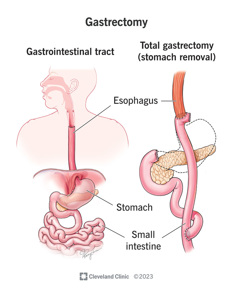Stomach (Gastric) Cancer Surgery