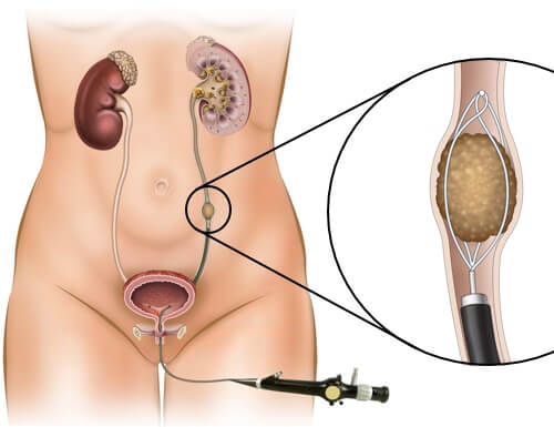 TUL (Transurethral Lithotripsy)