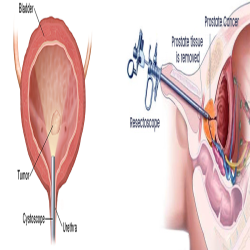 TURBT (Transurethral Resection of Bladder Tumor)