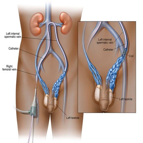 Varicocele Surgery