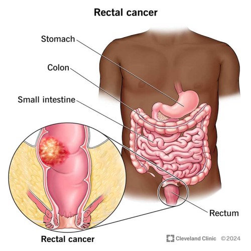 Rectal Cancer Surgery